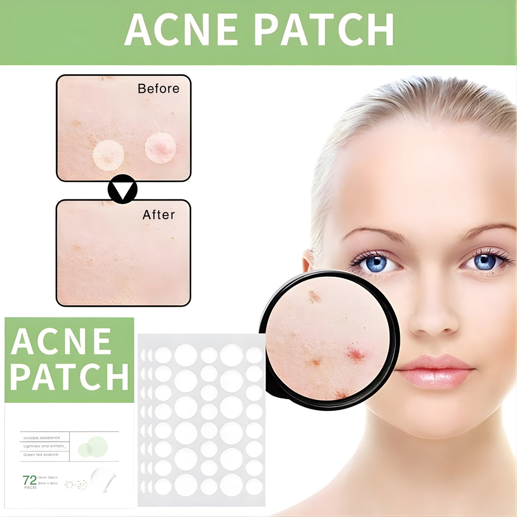 Anti-Acne Concealer Patch | Invisible Blemish Protection | 72 Patches