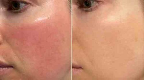 LED Therapy Face Mask | 7 Color Light Modes | Home Skin Care Device