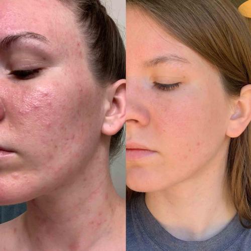 LED Therapy Face Mask | 7 Color Light Modes | Home Skin Care Device