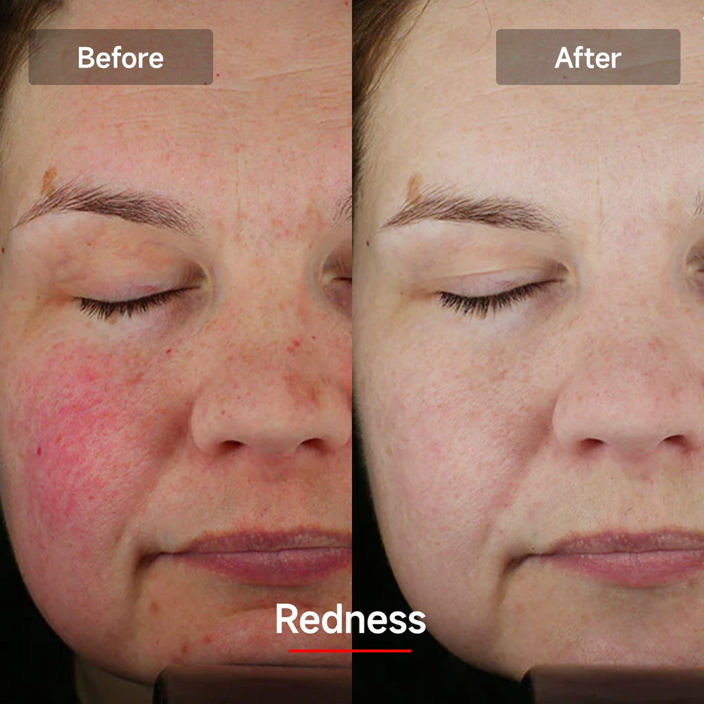 LED Red Light Nano Face Mask 2.0 | Light Therapy Facial Beauty Device | Home Use